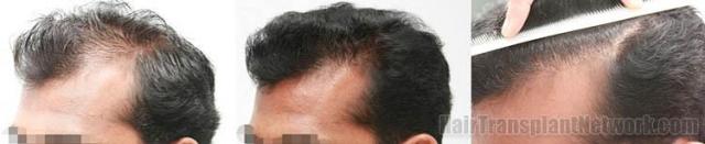 Hair restoration patient  before and result photographs