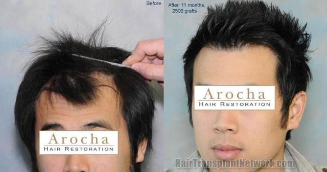 Before and after surgical hair restoration images