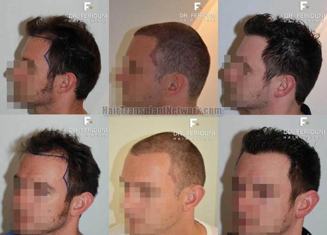 Hair transplantation surgery before and after photos