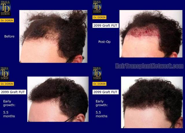 Hair transplantation surgery before and after images