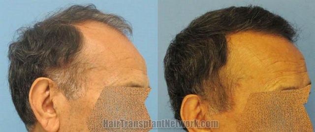 Right side views - Before and after hair replacement procedure