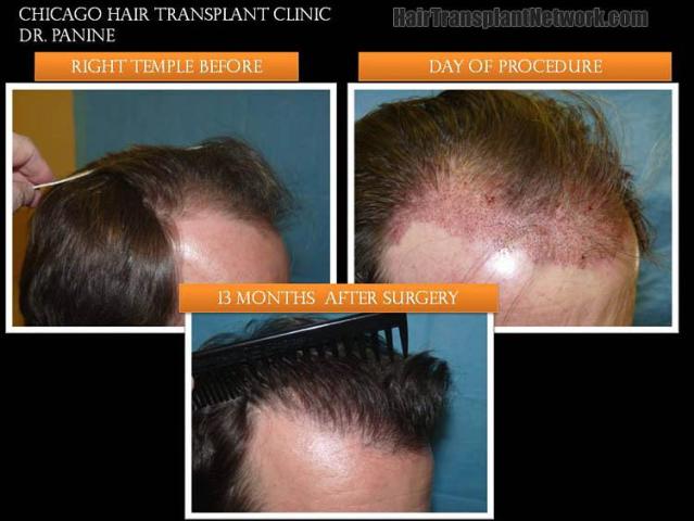 Hair restoration procedure before and after results