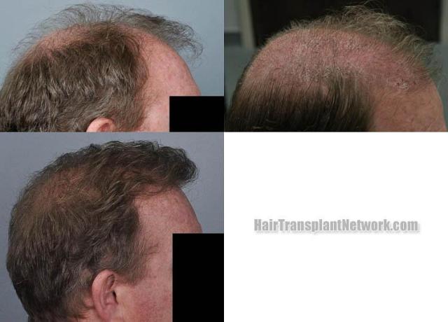 Hair transplantation surgery before and after images