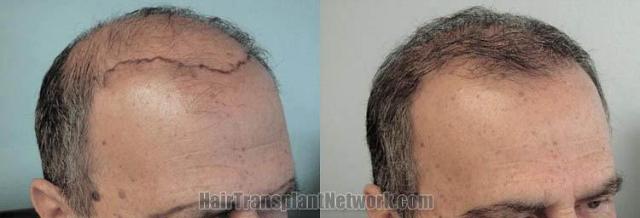 Hair transplantation surgery before and after photos