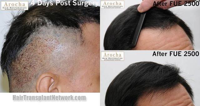 Hair transplantation surgery before and after images