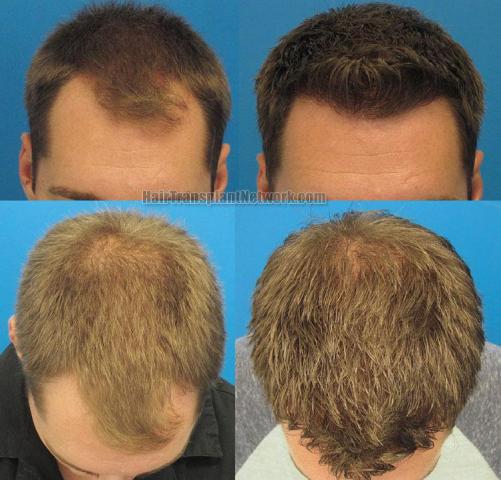 Hair restoration procedure before and after results