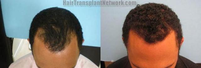 Hair transplantation surgery before and after images