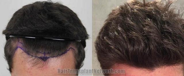 Top view before and after hair restoration results