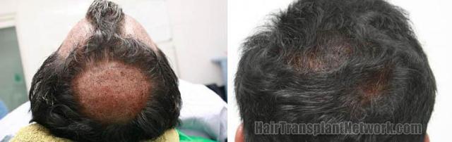 Back view before and after hair restoration images