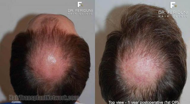 Hair restoration procedure results