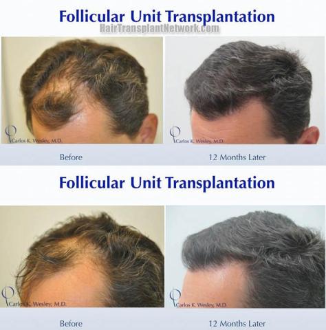 Hair restoration procedure before and after pictures