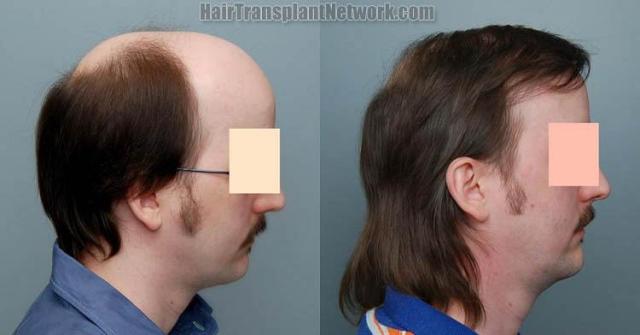 Right view before and after hair replacement images