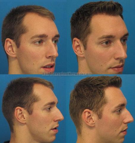 Hair transplantation surgery before and after pictures