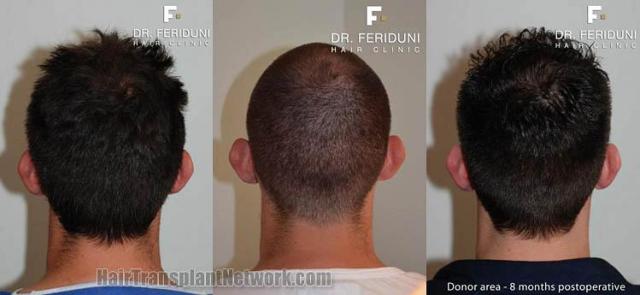 Hair transplantation surgery before and after images