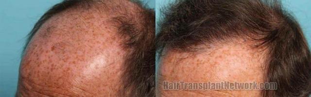 Images of before and after hair replacement procedure