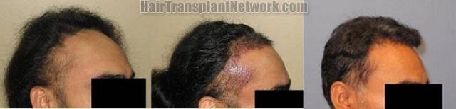 Hair restoration procedure results