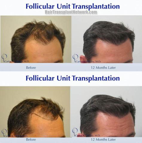 Hair transplantation surgery before and after pictures