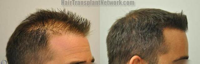 Before and after two hair transplantation procedure