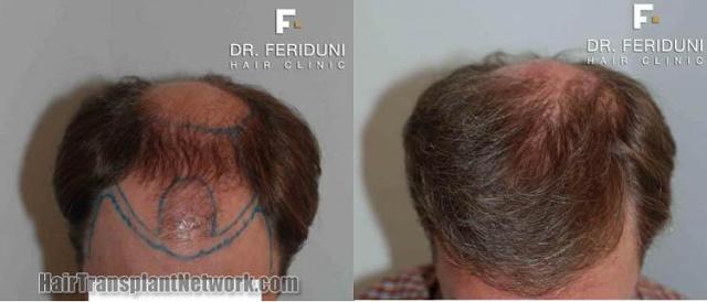 Top view before and after hair restoration procedure