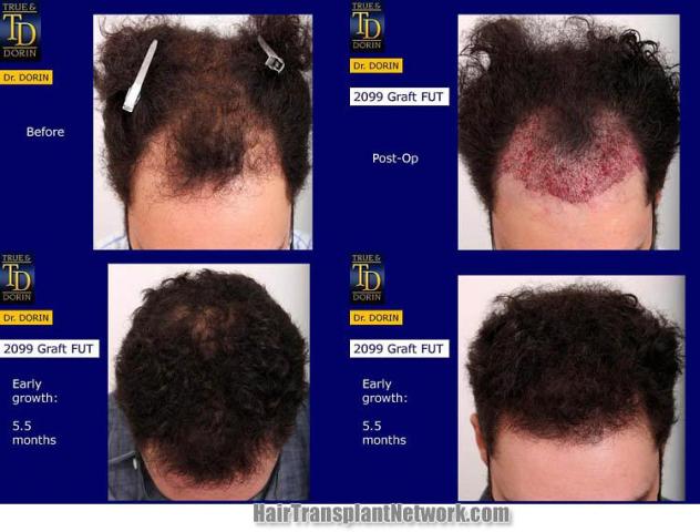 Hair restoration procedure before and after results