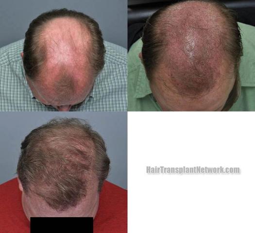 Hair transplantation surgery before and after photos