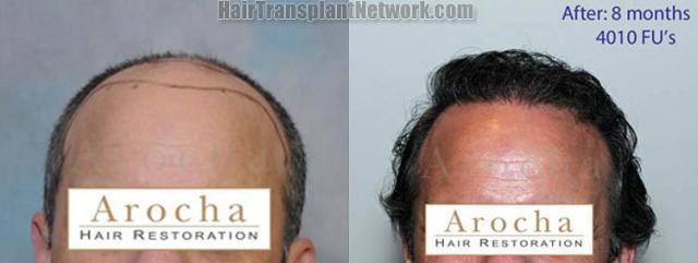 Hair transplantation surgery before and after photos