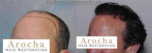 Hair transplantation surgery before and after pictures