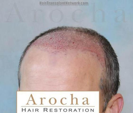 Hair restoration procedure before and after pictures