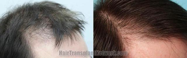 Right view before and after hair restoration procedure