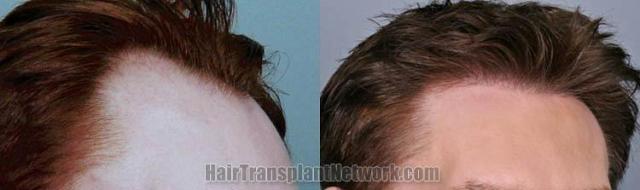 Hair restoration procedure before and after results