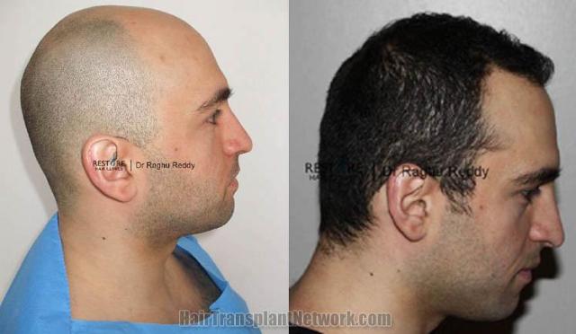 Hair transplantation surgery before and after photos