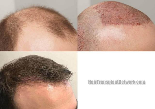 Hair restoration procedure before and after result images