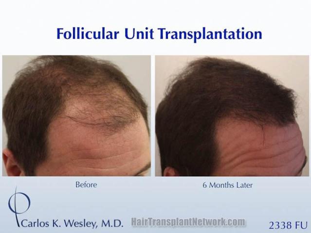 Hair restoration procedure after result images