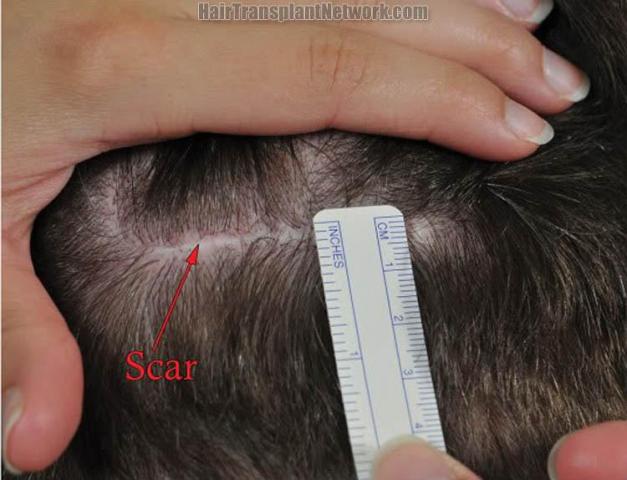 Residual scar of  patient
