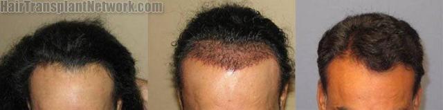 Before and after hair transplant procedure - Tilt down view