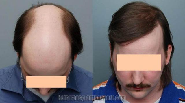 Hair restoration procedure before and after photos