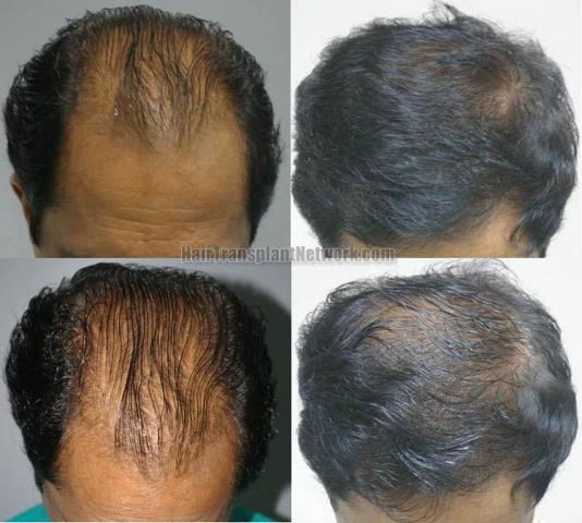 Before and after  with Finasteride