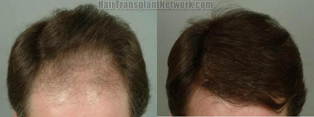 Top view - Before and after surgical hair replacement