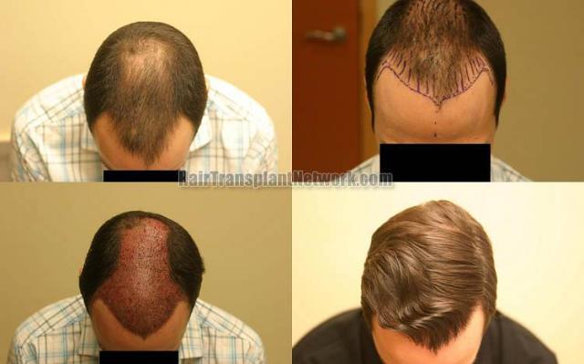 Hair restoration procedure before and after results