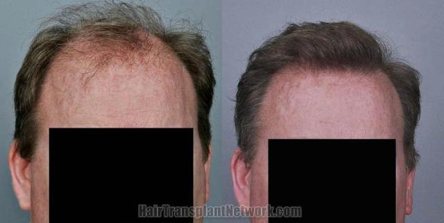 Hair restoration procedure before and after results