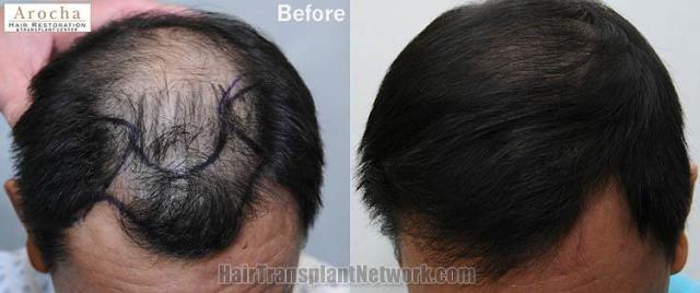 Hair transplantation surgery before and after photos