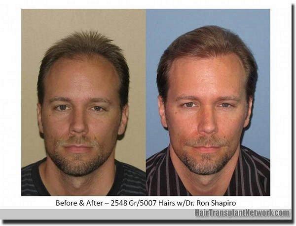 Hair restoration procedure results