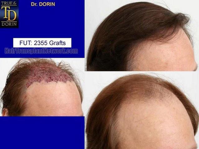 Right view images - Before and after hair transplant