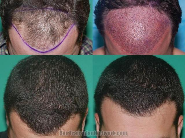 Top view before and after hair restoration results