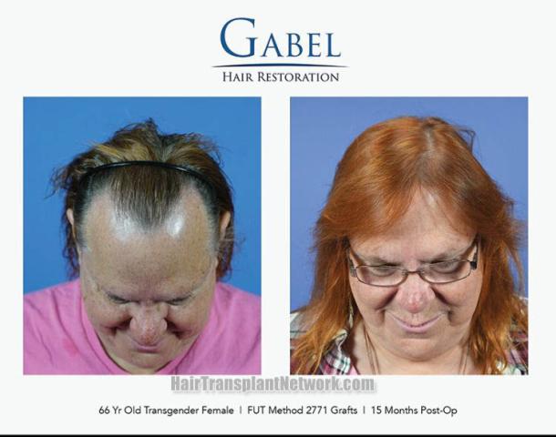 Hair replacement procedure before and after images