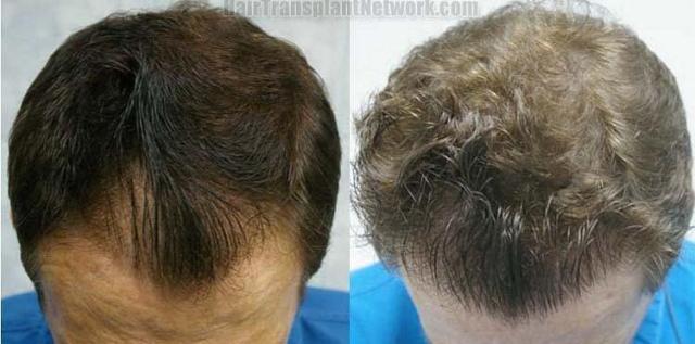 Before and three years postoperative hair transplant photos