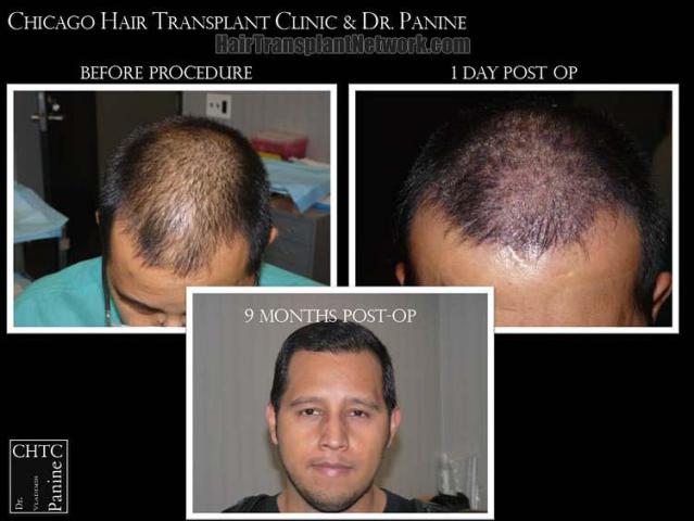 Hair restoration procedure before and after results