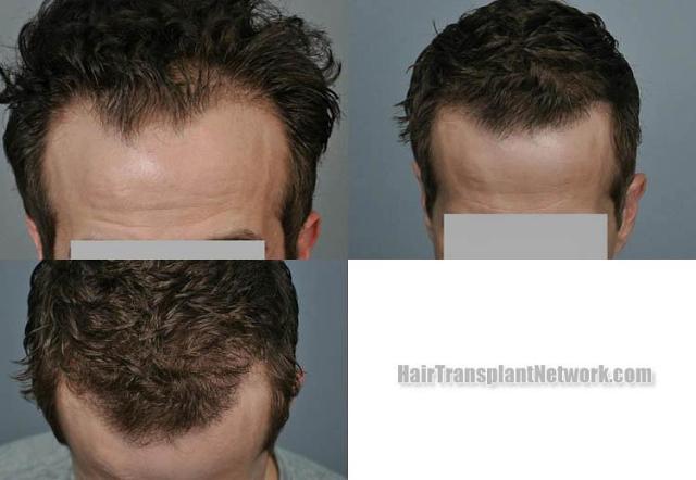 Hair transplantation surgery before and after photos