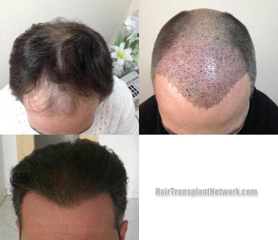 Top view - Before and after surgical hair replacement