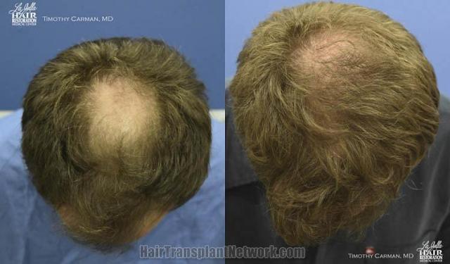 Hair restoration procedure before and after results